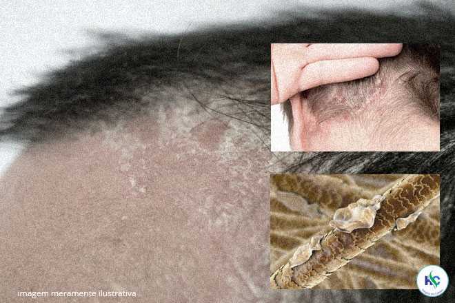 Exibição de lesões no couro cabeludo causadas pela dermatite seborreica