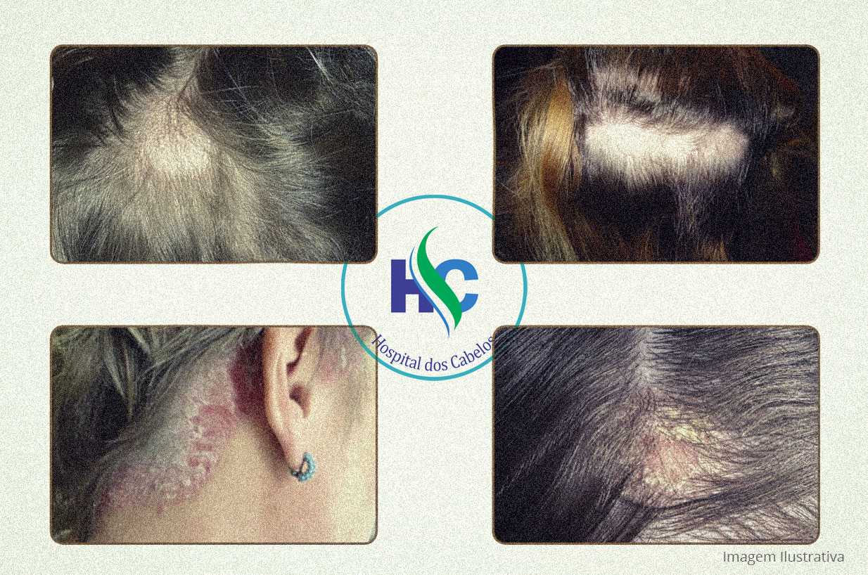 Close-up de couro cabeludo com lesões avermelhadas e escamosas causadas pela dermatite seborreica.